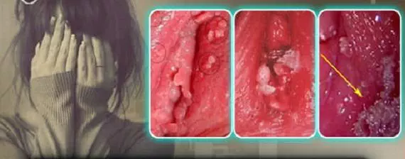 Sùi mào gà: 7 phương pháp điều trị hiệu quả và khả năng chữa khỏi hoàn toàn