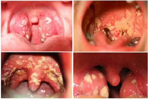 10 Phương pháp chữa bệnh lậu hiệu quả và cách phòng ngừa tái phát