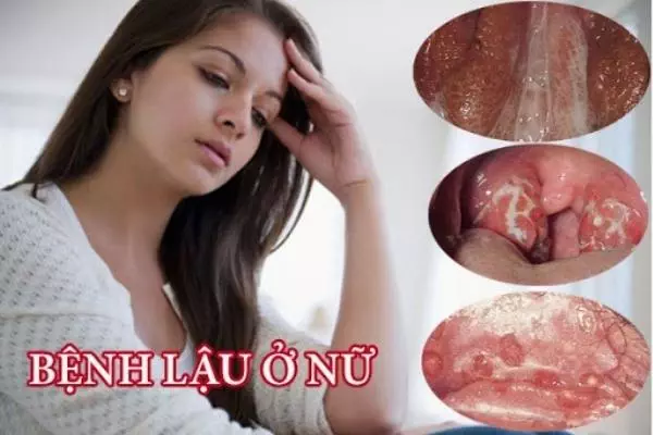 Tổng quan về bệnh lậu: Nguyên nhân, triệu chứng và 7 cách phòng ngừa hiệu quả