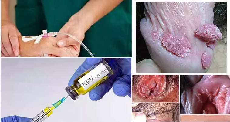 Top 10 phương pháp chữa sùi mào gà hiệu quả và cách phòng ngừa toàn diện